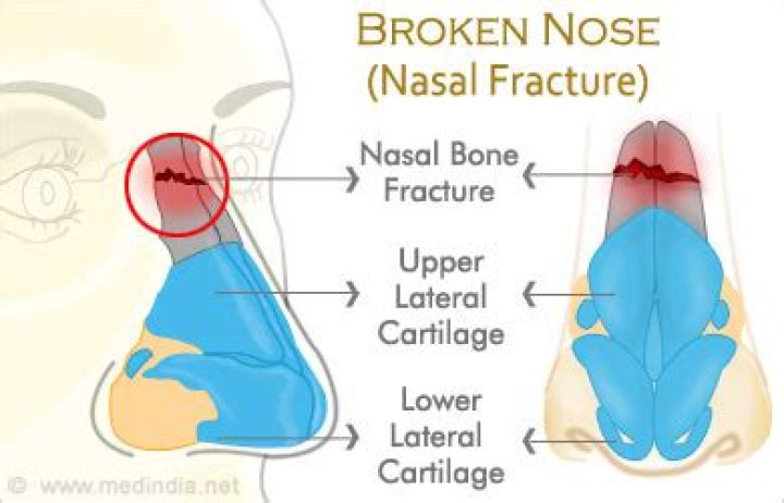 How to reset a broken nose